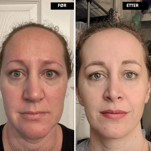 Clarivelle™ Det neste generasjons alternativet til retinol