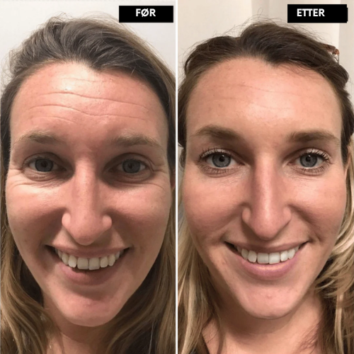 Clarivelle™ Det neste generasjons alternativet til retinol