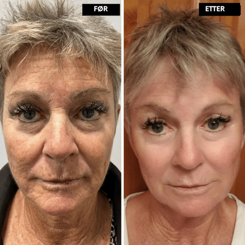 Clarivelle™ Det neste generasjons alternativet til retinol