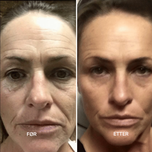 Clarivelle™ Det neste generasjons alternativet til retinol